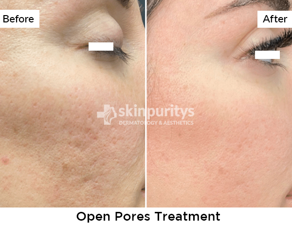 Open Pores results